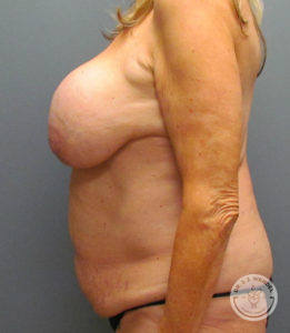 woman's torso right side profile before tummy tuck and breast implant removal