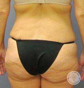 woman's backside before tummy tuck