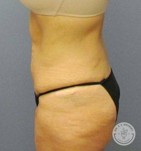 woman's torso side view before tummy tuck