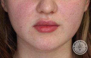 woman's lips close up before juvederm vollure injections