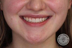 woman's lips smiling before juvederm vollure injections