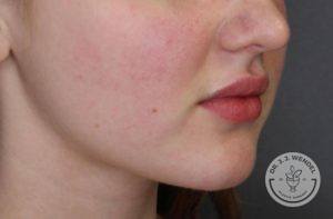 woman's lips side profile before juvederm vollure injections