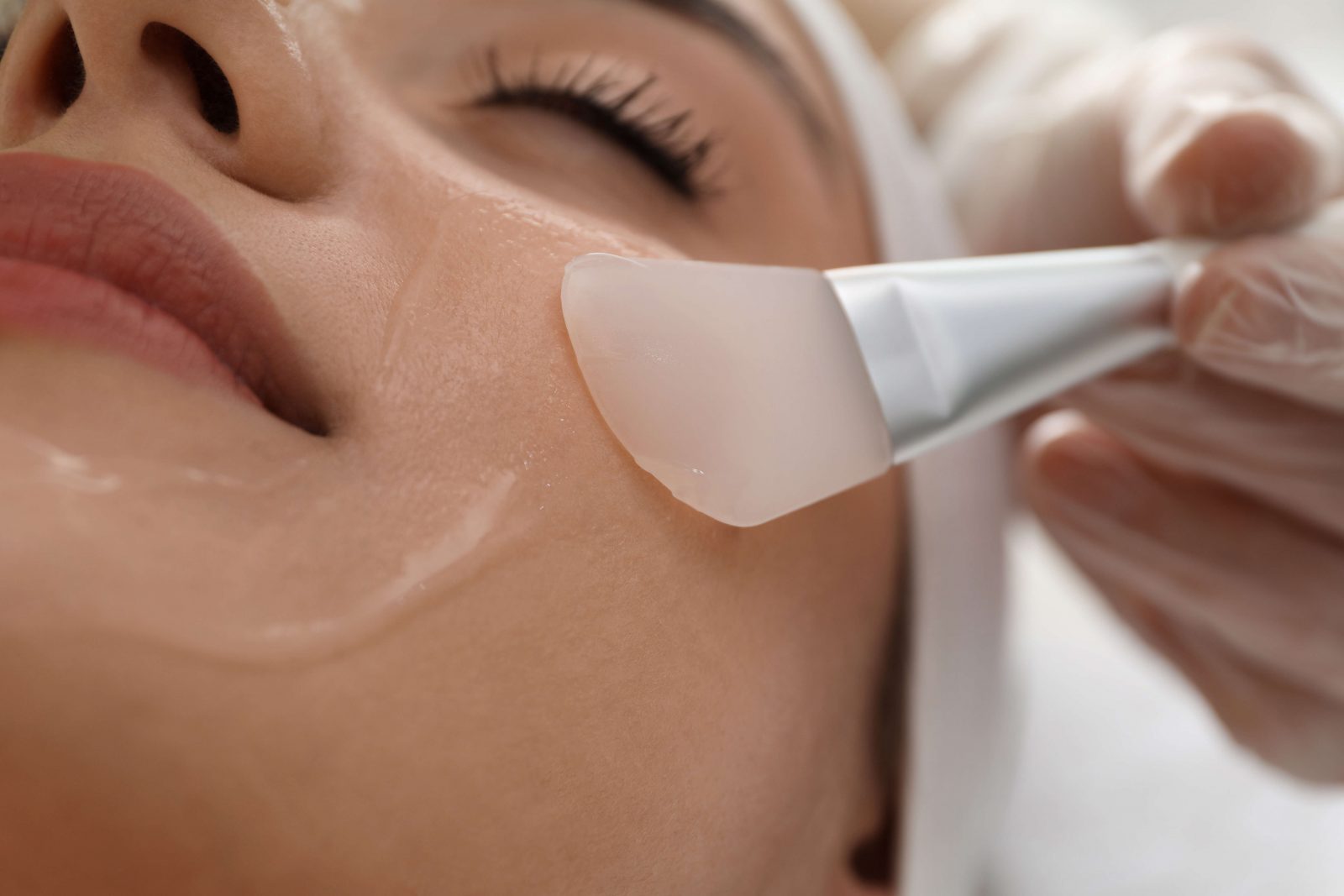 woman getting chemical peel