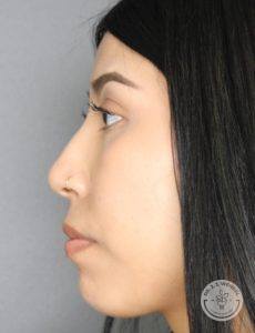 right side profile of woman after liquid rhinoplasty non-surgical nose job