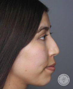 left side profile of woman before liquid rhinoplasty non-surgical nose job