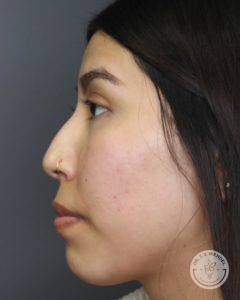 right side profile of woman before liquid rhinoplasty non-surgical nose job