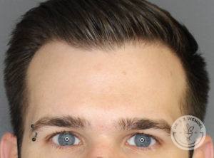 top half of man's face with eyebrow piercing after botox injections
