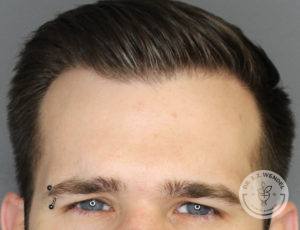 top half of man's face frowning with eyebrow piercing after botox injections
