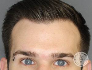 top half of man's face with eyebrow piercing raising eyebrows after botox injections