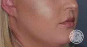 side profile of lower half of woman's face after juvederm vollure lip filler injections no smile