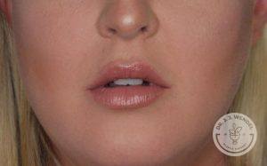 lower half of woman's face after juvederm vollure lip filler injections mouth open