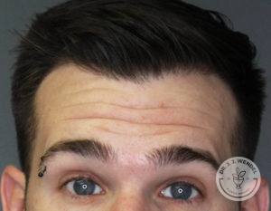 top half of man's face with eyebrow piercing lifting eyebrows before botox injections