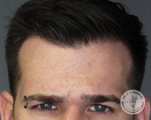 top half of man's face frowning with eyebrow piercing before botox injections