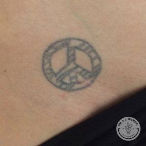 before tattoo removal of peace sign