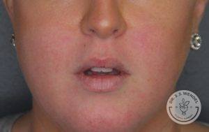 lower half of woman's face before juvederm vollure lip filler injections mouth open