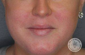 lower half of woman's face smiling no teeth before juvederm vollure lip filler injections