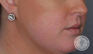side profile of bottom half of woman's face before juvederm vollure lip filler injections