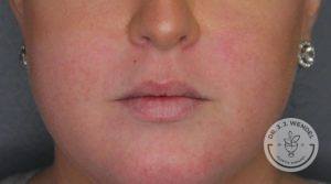 lower half of woman's face before juvederm vollure lip filler injections