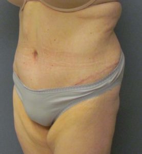 abdomen side after tummy tuck