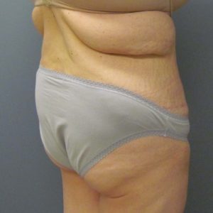 backside after tummy tuck