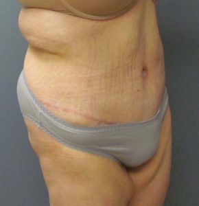 abdomen side after tummy tuck