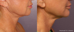morpheus8 before and after photos for neck