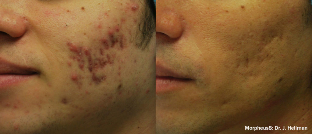 before after morpheus8 acne