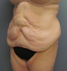 abdomen before tummy tuck