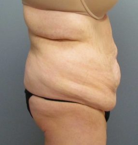 abdomen side before tummy tuck