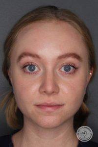 blonde woman raising eyebrows after botox