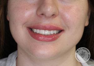 woman lower half of face smiling after lip filler in nashville at dr j j wendel plastic surgery
