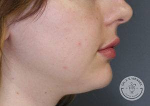woman lower half of face side profile after lip filler in nashville at dr j j wendel plastic surgery