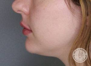 woman lower half of face side profile after lip filler in nashville at dr j j wendel plastic surgery
