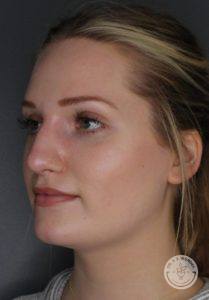 right side of woman's face after liquid nose job