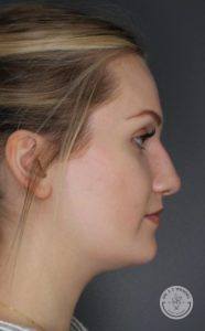 right side profile of woman with hair up after liquid nose job