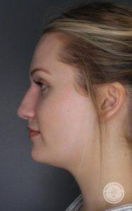 left side profile of woman with hair up after liquid nose job