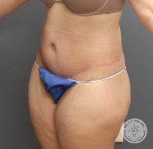 woman's side abdomen after tummy tuck