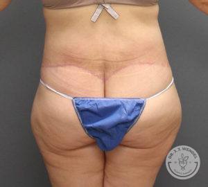 woman's backside after tummy tuck
