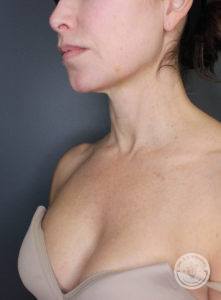Chest and neck before photo of woman receiving Halo and BBL Laser treatment in Nashville, TN.