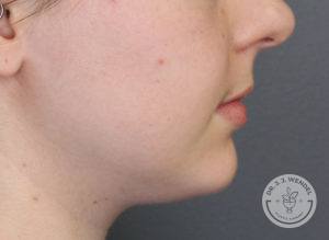 woman lower half of face side profile before lip filler in nashville at dr j j wendel plastic surgery