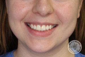 woman lower half of face smiling before lip filler in nashville at dr j j wendel plastic surgery