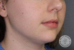 woman lower half of face side front profile before lip filler in nashville at dr j j wendel plastic surgery