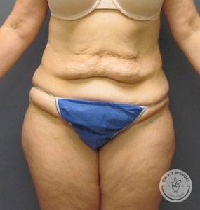 woman's front abdomen before tummy tuck