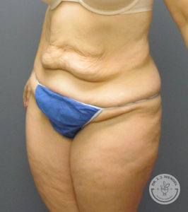 woman's abdomen before tummy tuck
