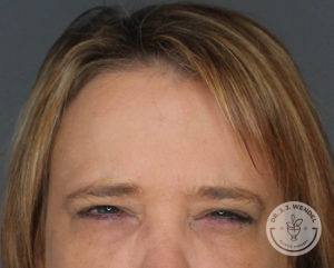 blonde woman top half of face frowning after botox in nashville at dr j j wendel plastic surgery