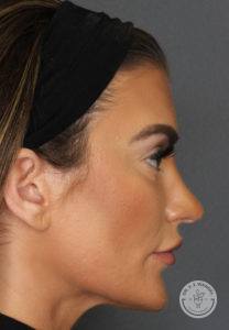 woman's left side of face profile after rhinoplasty at Dr. J. J. Wendel Plastic Surgery in Nashville