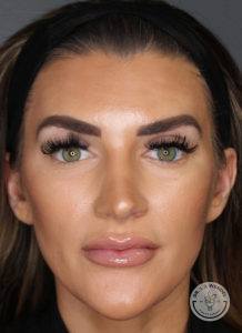 woman's face after rhinoplasty at Dr. J. J. Wendel Plastic Surgery in Nashville