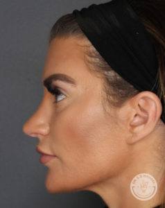 woman's right side of face profile after rhinoplasty at Dr. J. J. Wendel Plastic Surgery in Nashville