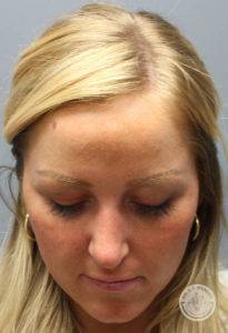 woman's face tipped slightly downwards after rhinoplasty in Nashville at Dr. J. J. Wendel Plastic Surgery