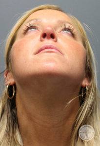 woman's face tipped upwards after rhinoplasty in Nashville at Dr. J. J. Wendel Plastic Surgery